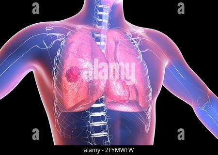 Pulmonary mucormycosis, illustration Stock Photo