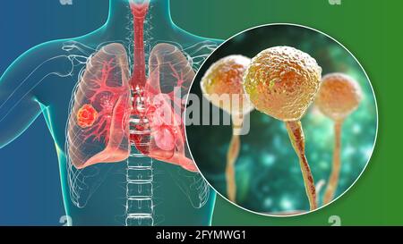 Pulmonary mucormycosis, illustration Stock Photo