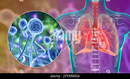 Pulmonary mucormycosis, illustration Stock Photo