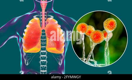 Pulmonary mucormycosis, illustration Stock Photo