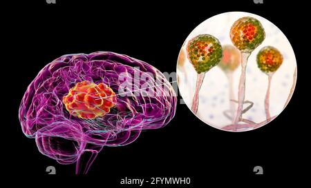 Brain mucormycosis, illustration Stock Photo - Alamy