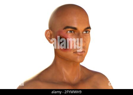 Cutaneous mucormycosis, illustration Stock Photo