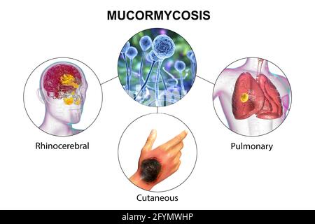 Clinical forms of mucormycosis, illustration Stock Photo - Alamy