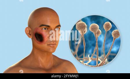 Cutaneous mucormycosis, illustration Stock Photo