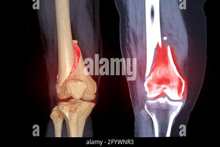 CT knee joint Coronal view isolated on black background showing ...