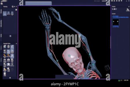 CTA brachial artery or CT scan of upper extremity or the Arm 3d rendering image on blurred screen. Stock Photo