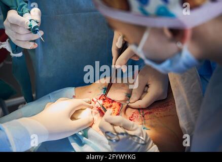 Close up of medical workers in sterile gloves doing plastic surgery in clinic. Plastic surgeon and assistants using medical instruments. Concept of medicine, abdominoplasty and cosmetic surgery. Stock Photo