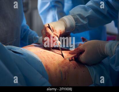 Close up of surgeon hands in sterile gloves cutting excess skin with scalpel while performing abdominoplasty surgery in operating room in hospital. Concept of abdominal plastic surgery. Stock Photo