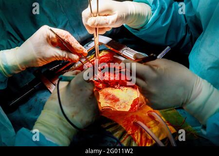 Surgeon surgery and team perform thoracic surgery in case lung cancer Stock Photo