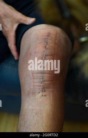 NFL's Taylor Lewan Reveals Gnarly, Bloody Scar After ACL Surgery