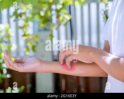 Young boy scratching the itch on his arm skin red rash. The allergy itch skin from mosquito bite, skin include dermatitis (eczema), food or drugs alle