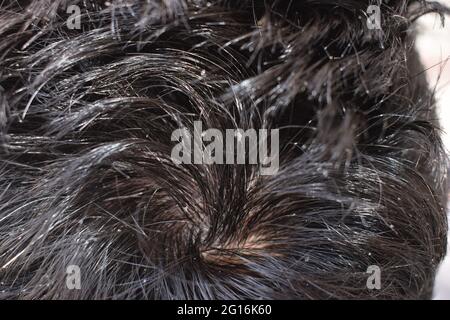 Men's hair is a top view close-up with Gray hair and Dandruff Stock Photo