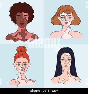 World Vitiligo Day. Women faces who have vitiligo pigment spots. Isolated portraits - vector set Stock Vector