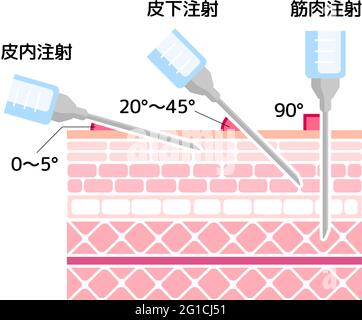 Angles for Inserting Injections vector illustration Stock Vector