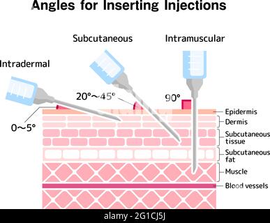 Angles for Inserting Injections vector illustration Stock Vector