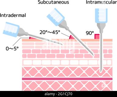 Angles for Inserting Injections vector illustration Stock Vector