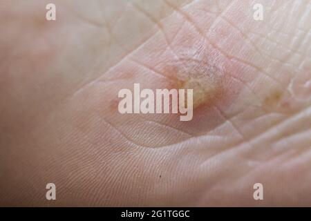 Dyshidrotic Eczema On The Foot Blister Dermatitis Treated With Ointment Close Up Shot Stock