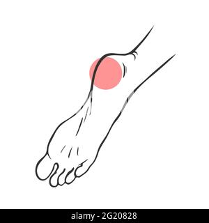 Leg with heel pain. Orthopedic disease plantar fasciitis. Vector isolated outline illustration Stock Vector