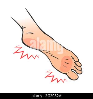 Leg with heel pain. Orthopedic disease plantar fasciitis. Vector isolated outline illustration Stock Vector