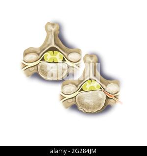 View of vertebra with spinal stenosis showing trapped nerve, compared to a normal vertebra on left. Stock Photo