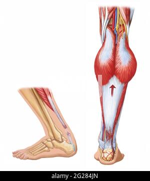 Side and back view of ruptured achilles tendon. Stock Photo