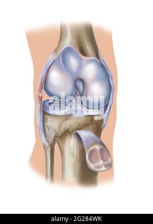 Front view of knee showing lateral collateral ligament tear. Stock Photo