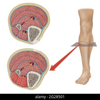 Lower leg showing normal and compression of lateral and anterior compartments. Stock Photo