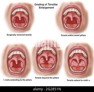 Various stages of tonsillar enlargement, looking into an open mouth. Stock Photo