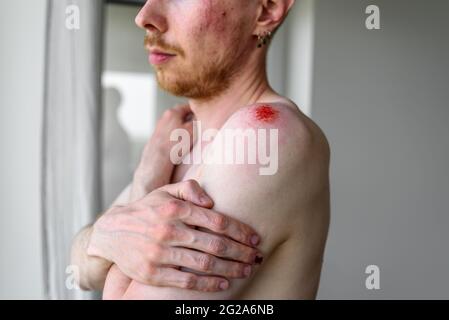 Man with many wounds on skin hugging yourself. Domestic violence, accident, fight concept Stock Photo