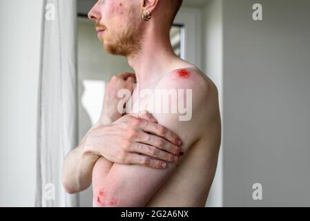 Man with many wounds on skin hugging yourself. Domestic violence, accident, fight concept Stock Photo