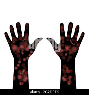 Meningitis rash on darker skin tones. Hands covered with red rash. Disease in ethnic minorities. Spots on hands. Medical signs and symptoms of disease Stock Vector
