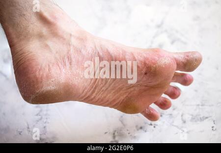 The disease on the man's leg. Dry foot. Stock Photo