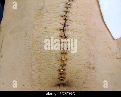 Rectal Cancer Incision after Surgery. Gastrointestinal wound . Operation of obstruction of rectal cancer Stock Photo