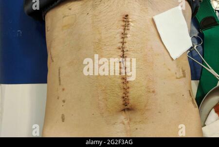 Rectal Cancer Incision after Surgery. Gastrointestinal wound . Operation of obstruction of rectal cancer Stock Photo