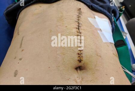 Rectal Cancer Incision after Surgery. Gastrointestinal wound . Operation of obstruction of rectal cancer Stock Photo