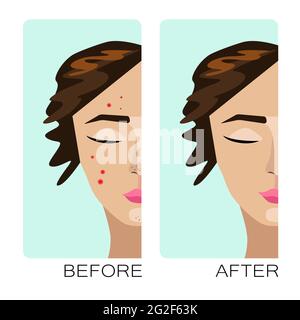 Woman face with acne problems, pimples, blemish skin, hormones, pollution. Young white girl character personal care. Before after concept image. Cosme Stock Vector