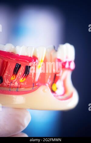 Tooth decay dentists dental model of teeth, gums and root canal Stock Photo