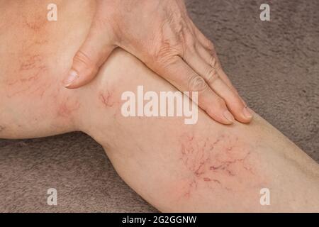An elderly woman's hand touches her sick leg with vein thrombosis, varicose veins. Stock Photo