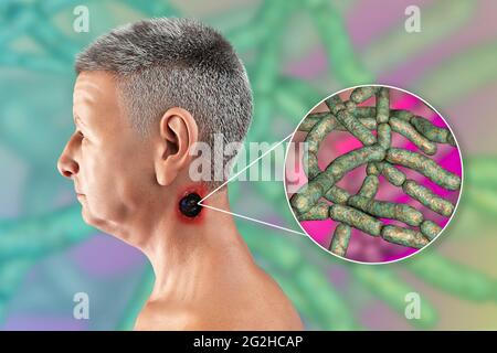 Cutaneous anthrax, illustration Stock Photo