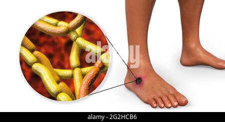 Cutaneous anthrax, illustration Stock Photo