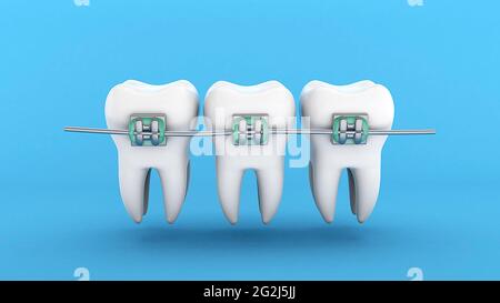 Teeth braces. Teeth alignment. Three white teeth with braces on a blue background. 3d render. Stock Photo