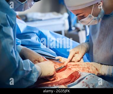 Plastic surgeon and assistant performing plastical surgical operation in operating room, removing excess fat from patient abdomen in hospital. Concept of abdominoplasty and cosmetic surgery. Stock Photo