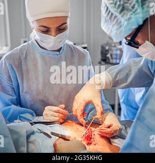 Medical workers in surgical suits performing abdominoplasty surgery in operating room. Male plastic surgeon and female assistant stitching open wound after abdominal plastic surgery. Stock Photo