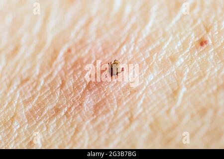 Engorged, feeding adult female deer tick, Ixodes scapularis, laying red eggs, protruding under it's body, sucking blood from skin of human female. Stock Photo