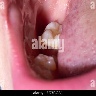 Hole after removal of a chewing tooth in the mouth. Healing of the gums ...