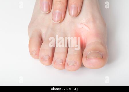 The girl applies a healing ointment between the toes against fungus and sweating of the feet, close-up Stock Photo