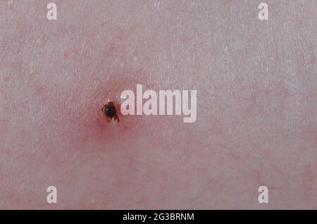Lone Star Tick, Amblyomma americanum, nymph attached to human skin