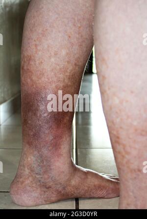 Leg suffering from Chronic Venous Insufficiency with mild cellulitis in her legs. Trying to walk and exercise to reduce heaviness swelling pain redness Stock Photo