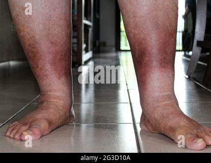 Leg suffering from Chronic Venous Insufficiency with mild cellulitis in her legs. Trying to walk and exercise to reduce heaviness swelling pain redness Stock Photo