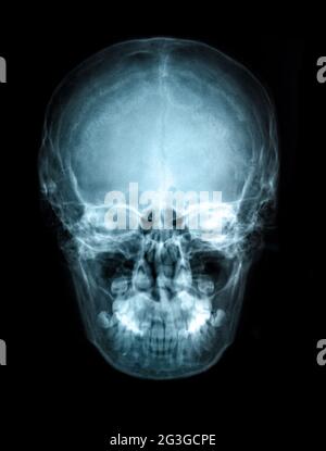 Human skull X-ray image view image isolated on black Stock Photo